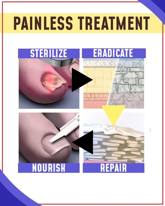 Kompleti za zdravljenje z modro svetlobo proti glivicam - slika 2