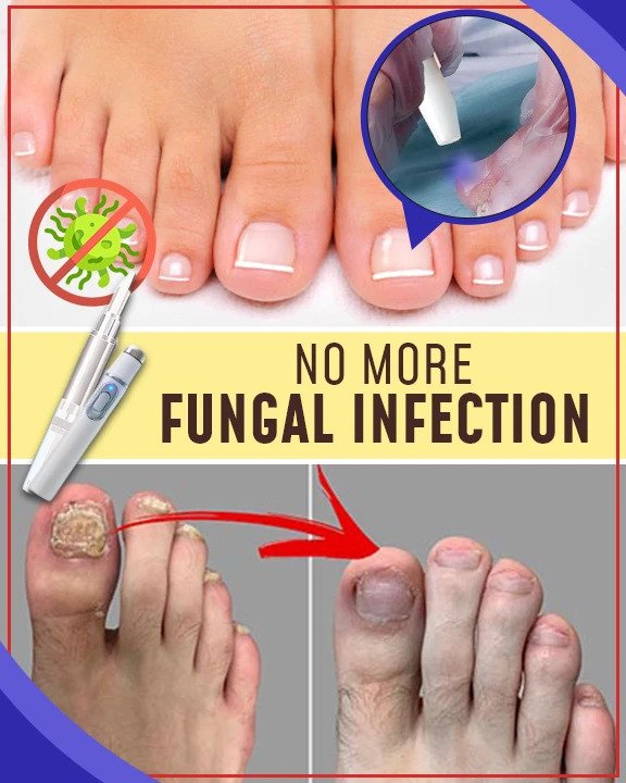 Kompleti za zdravljenje z modro svetlobo proti glivicam - slika 3