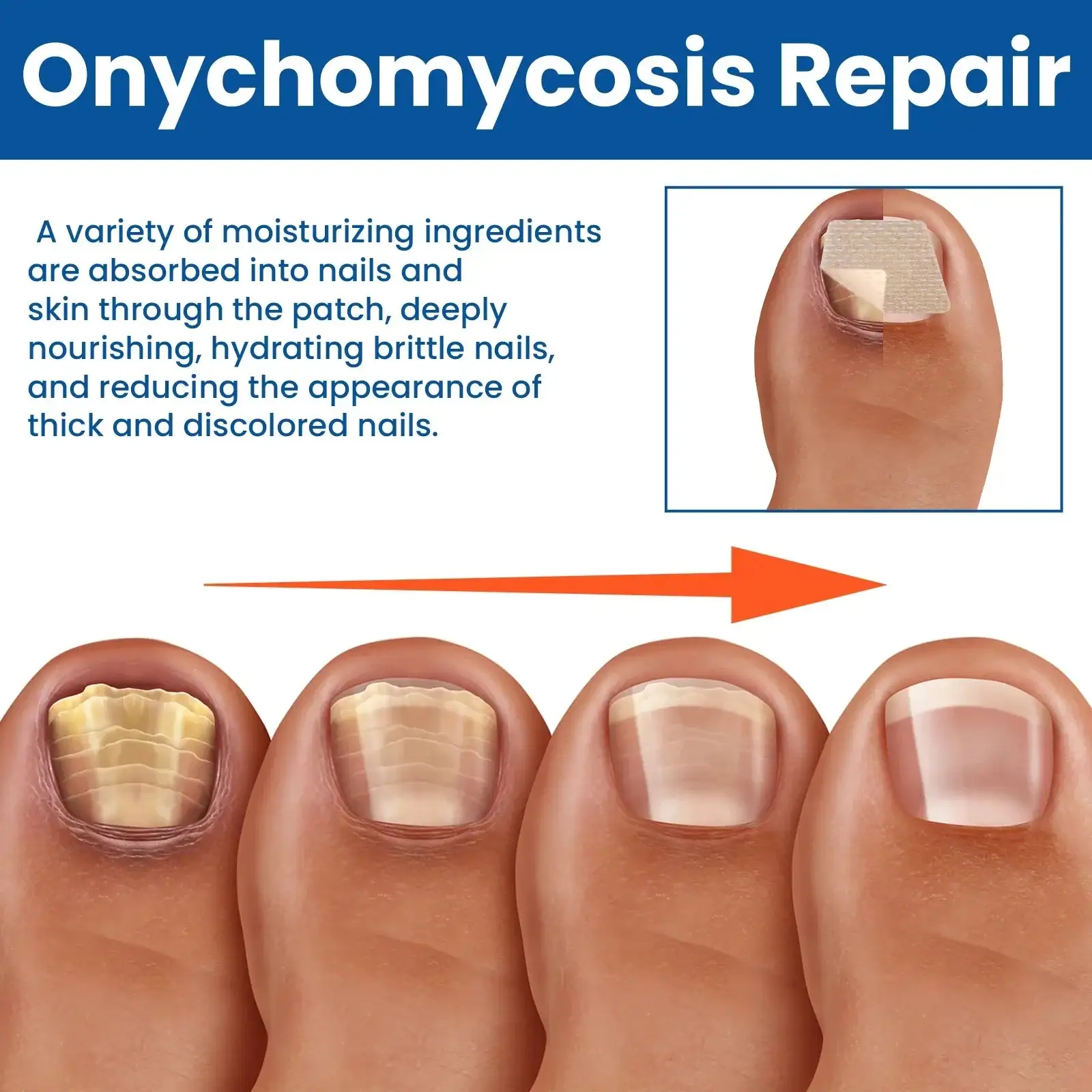 Obliži za popravilo glivic na nohtih - slika 4